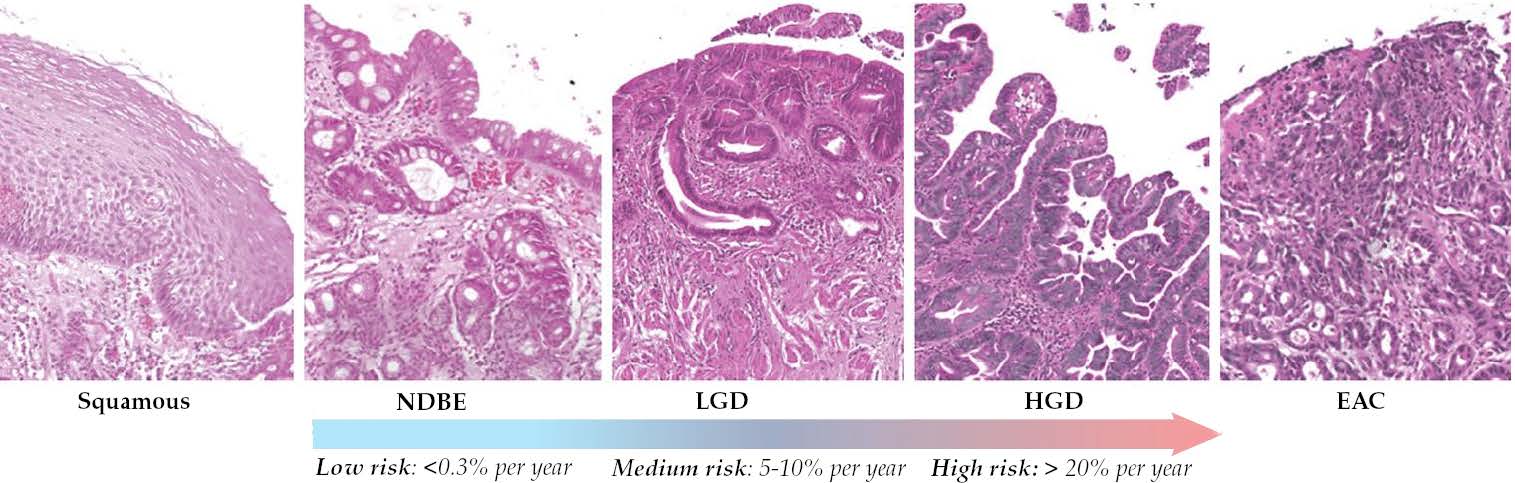 Modeling Barrett's Esophagus Progression Using Geometric Variational Autoencoders